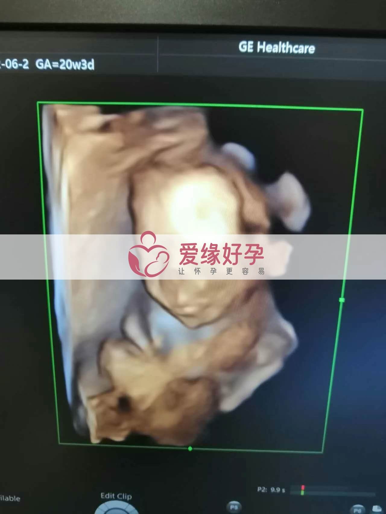 代孕代孕代母20周产检顺利通过