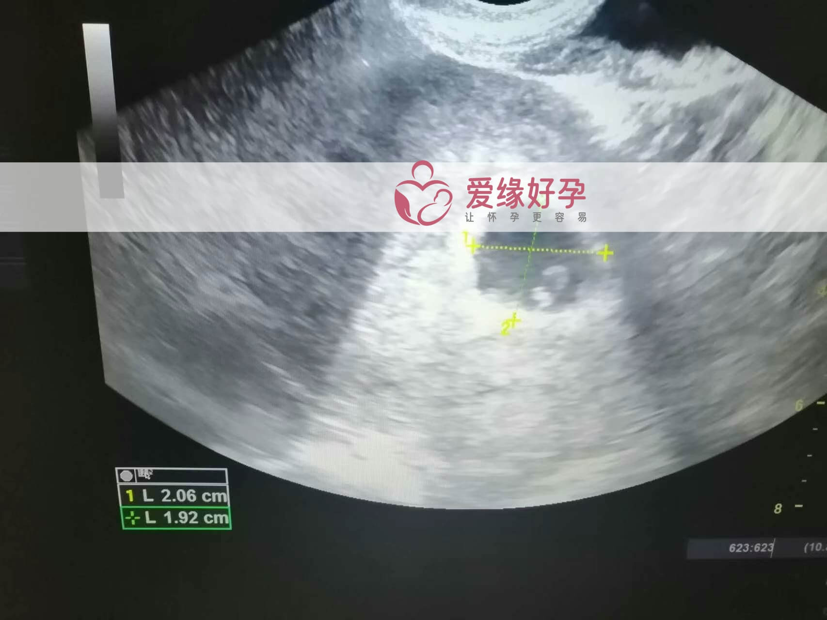 代孕代孕代母5周孕检通过