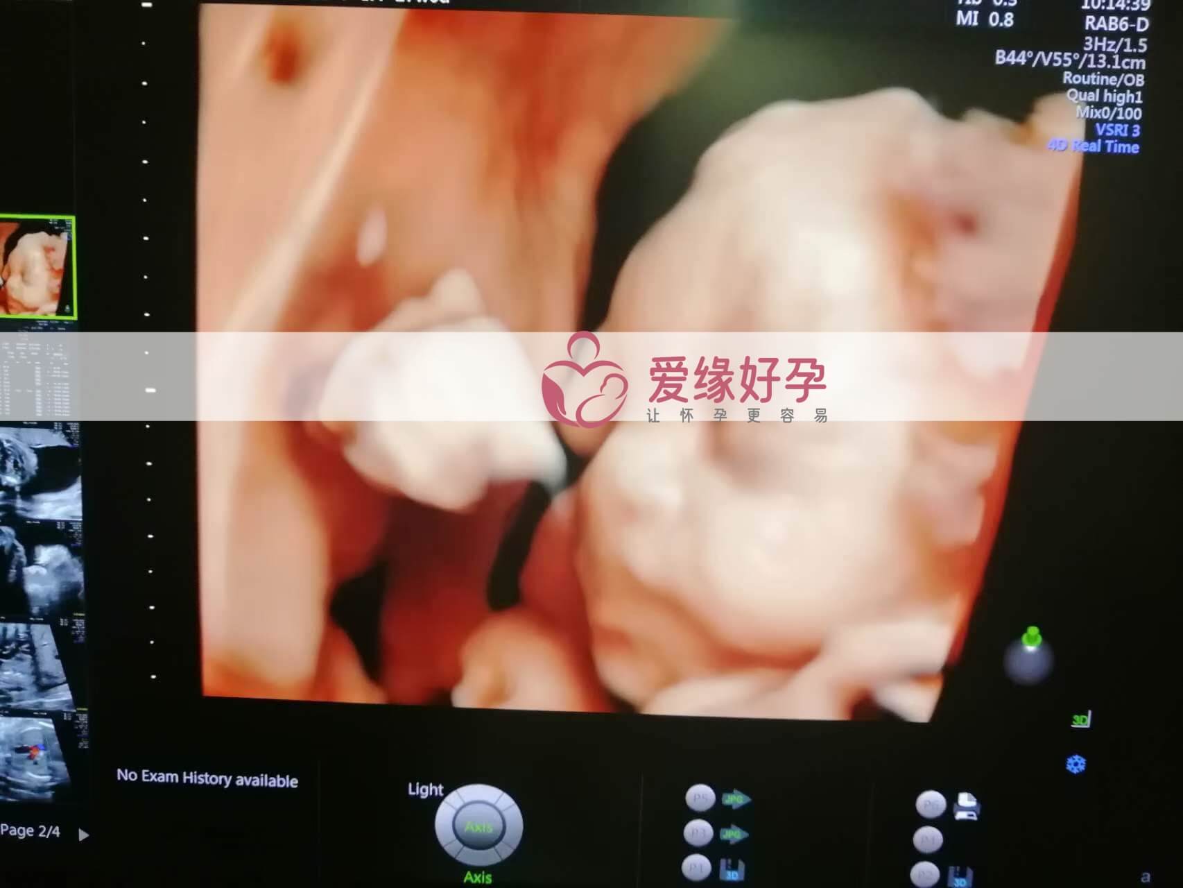 代孕代孕代母27周产检顺利通过