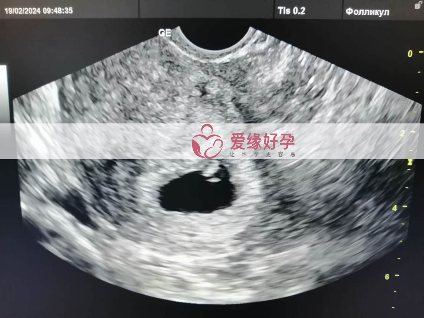 代孕代孕代母5周产检顺利通过