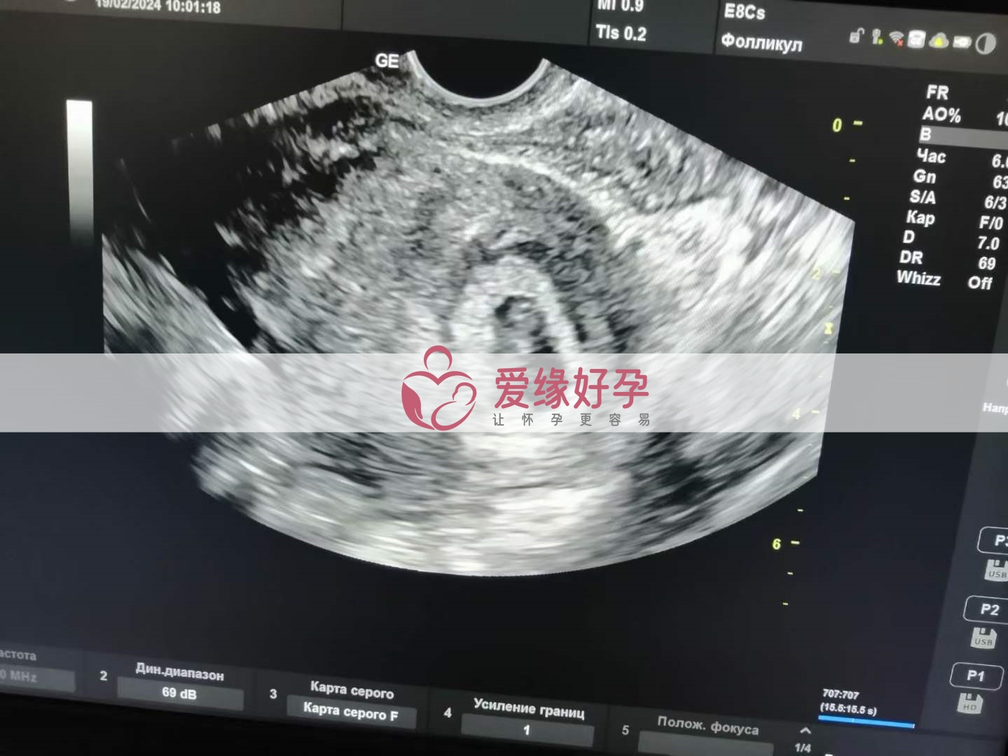 代孕代孕代母6周产检顺利通过