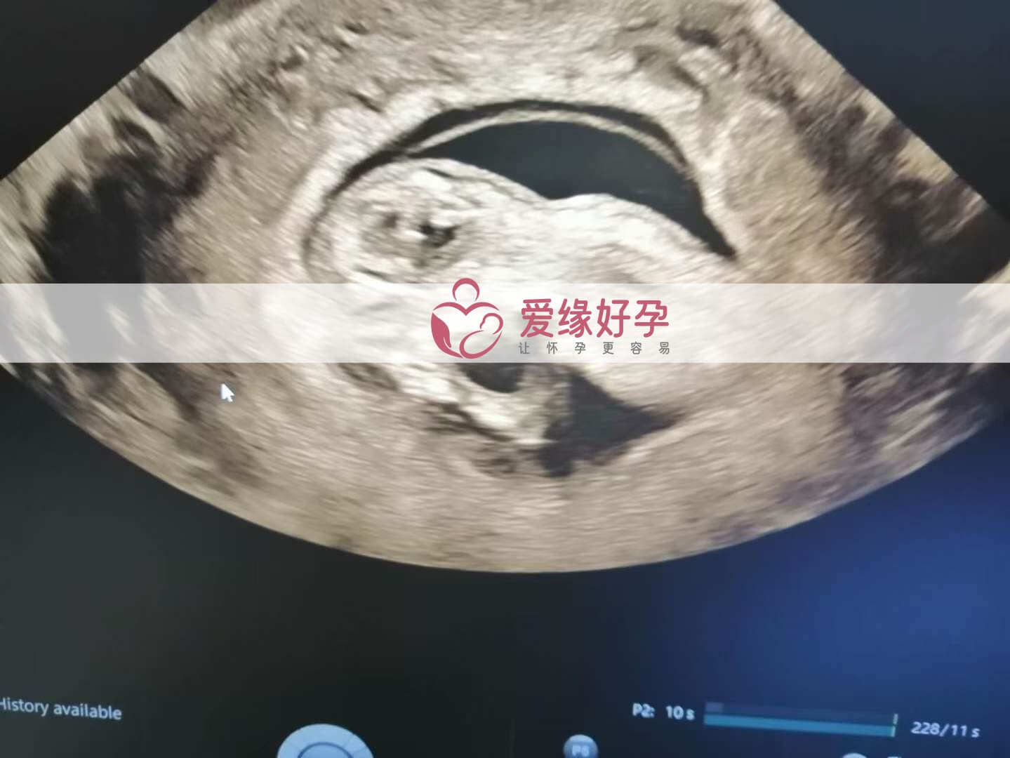 代孕代孕代母12周产检顺利通过