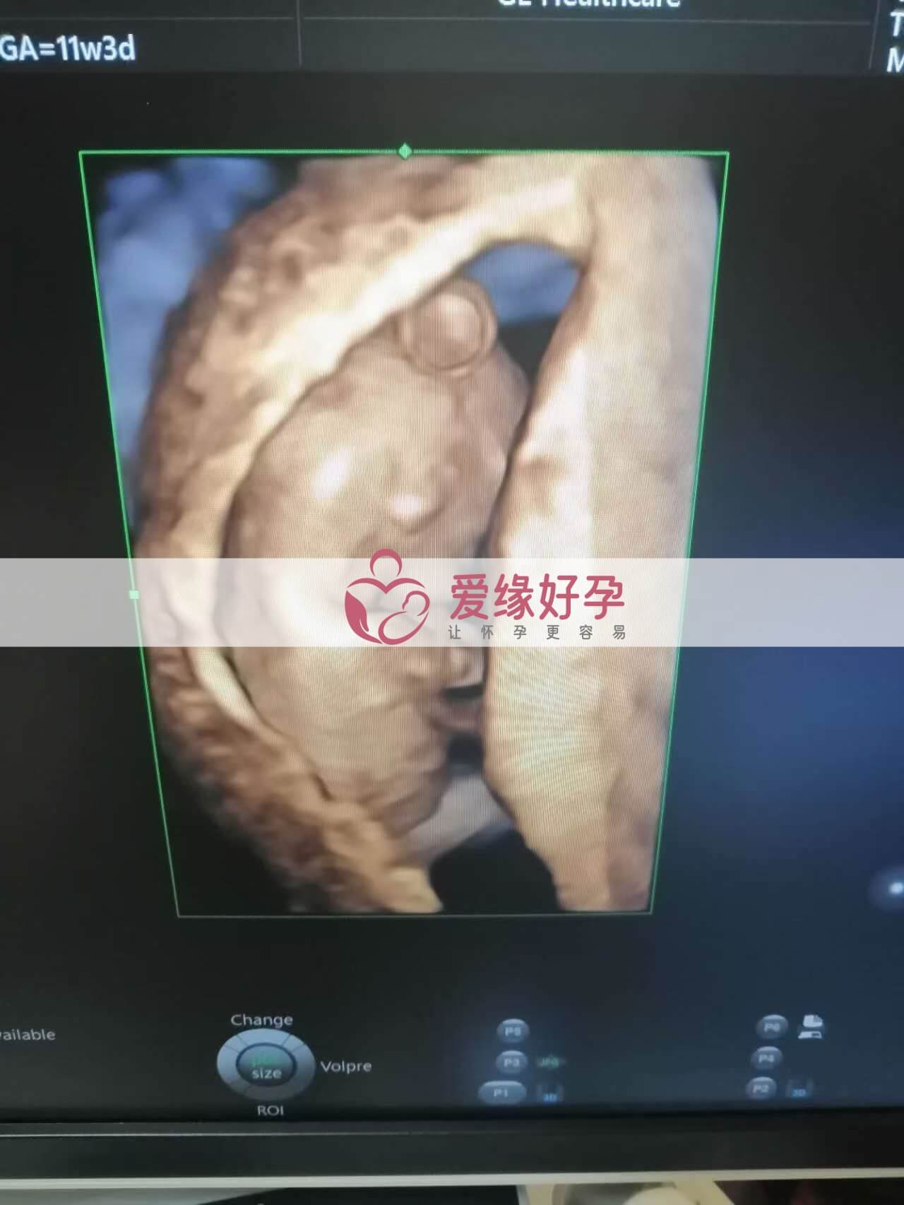 代孕代孕代母12周产检顺利通过