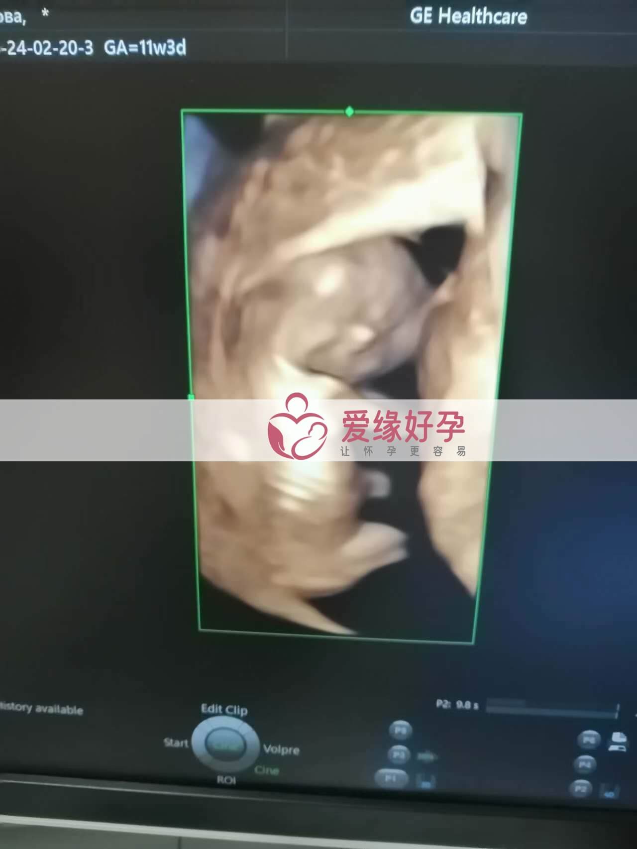 代孕代孕代母12周产检顺利通过