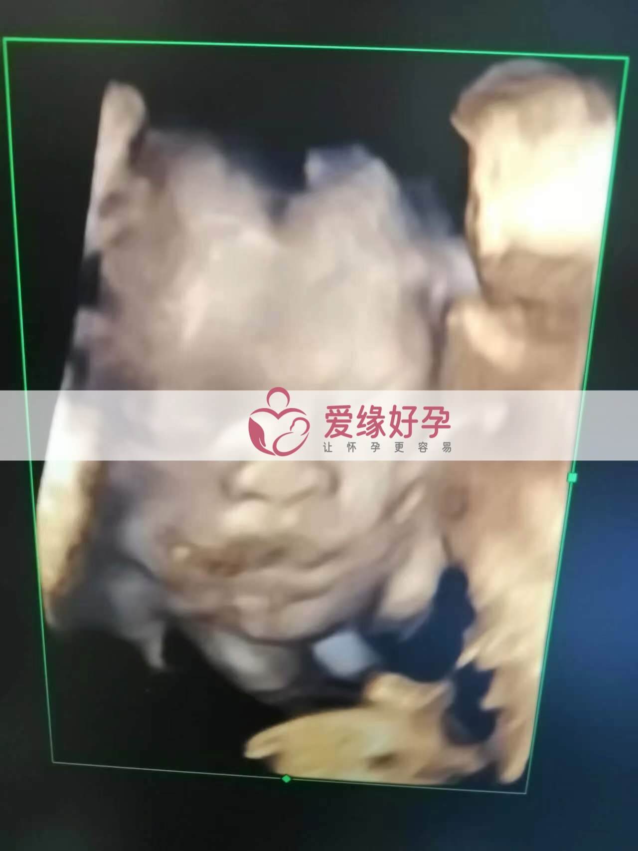 代孕代孕代母26周产检顺利通过