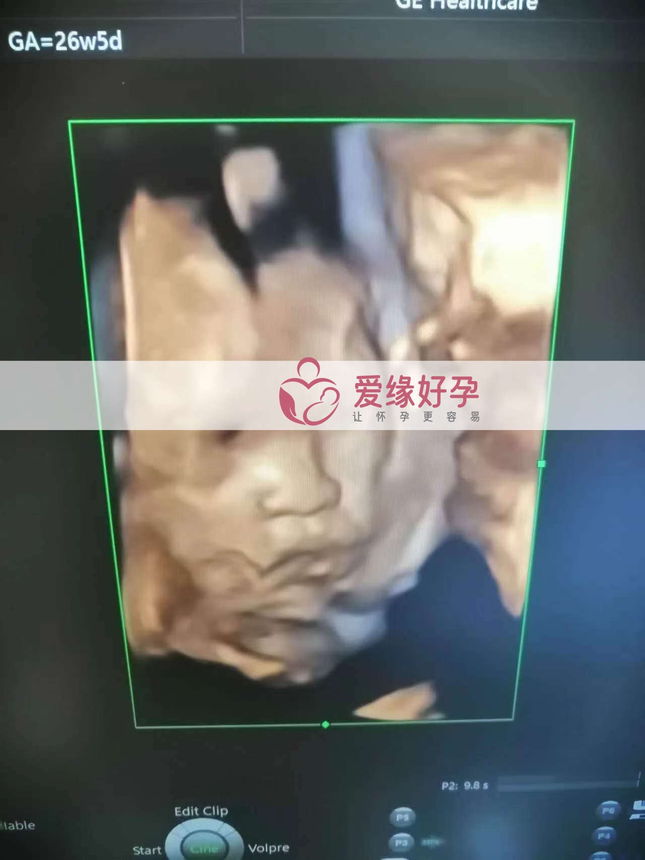 代孕代孕代母26周产检顺利通过