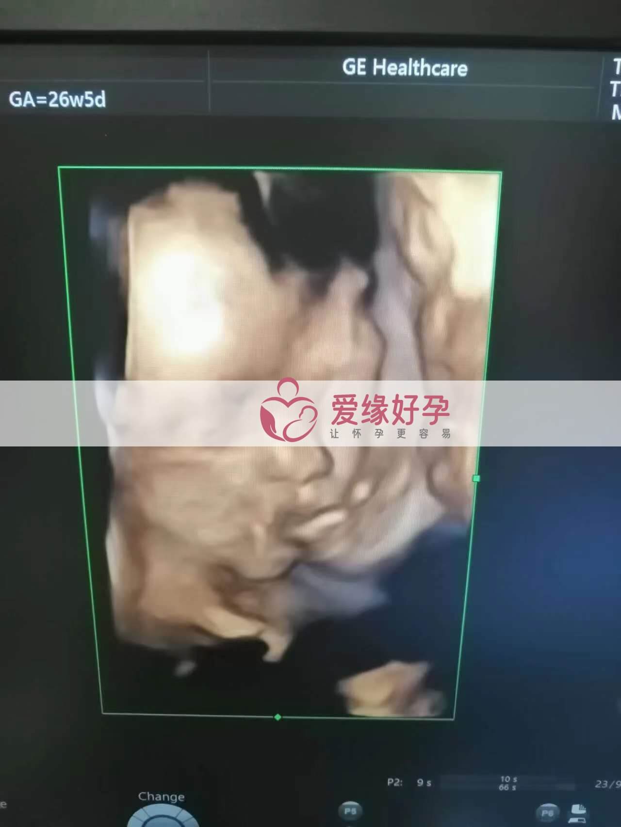 代孕代孕代母26周产检顺利通过
