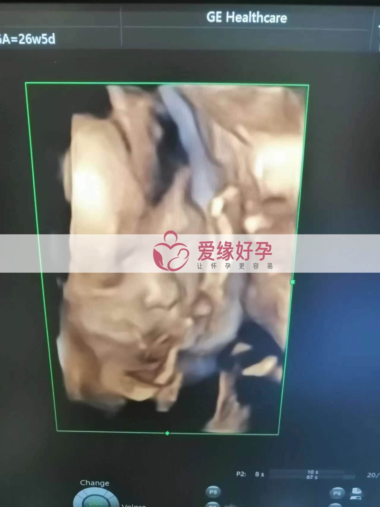 代孕代孕代母26周产检顺利通过