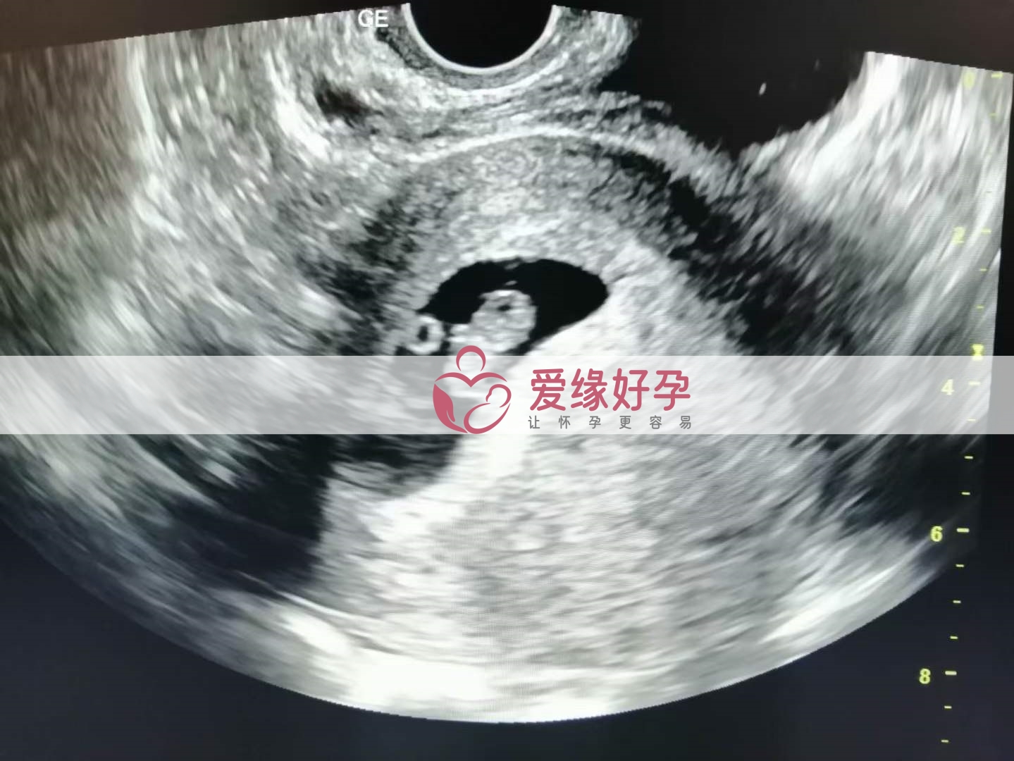 代孕代孕代母8周产检顺利通过