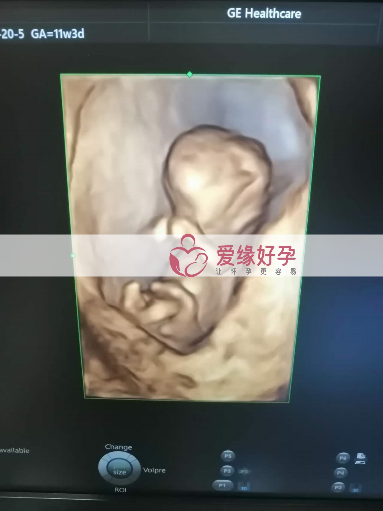 代孕代孕代母12周NT检查顺利通过
