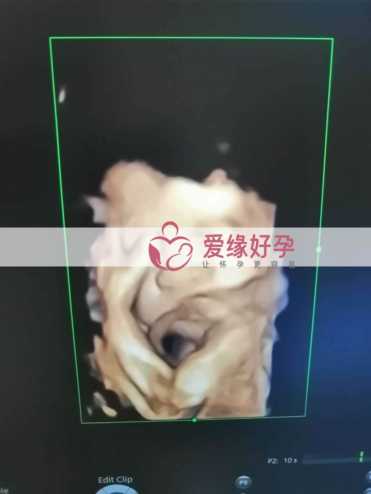代孕代孕代母31周孕检顺利通过