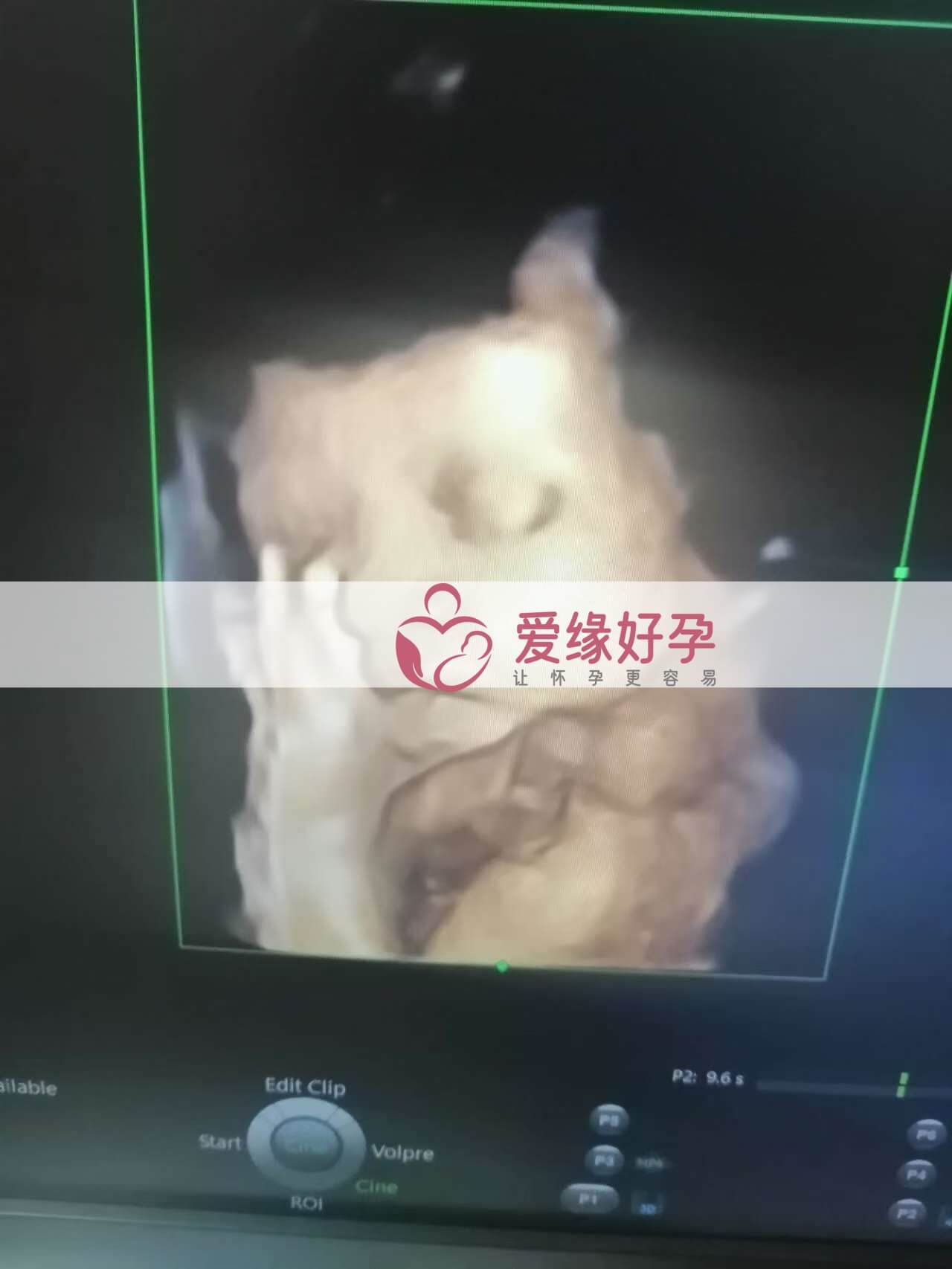 代孕代孕代母31周孕检顺利通过