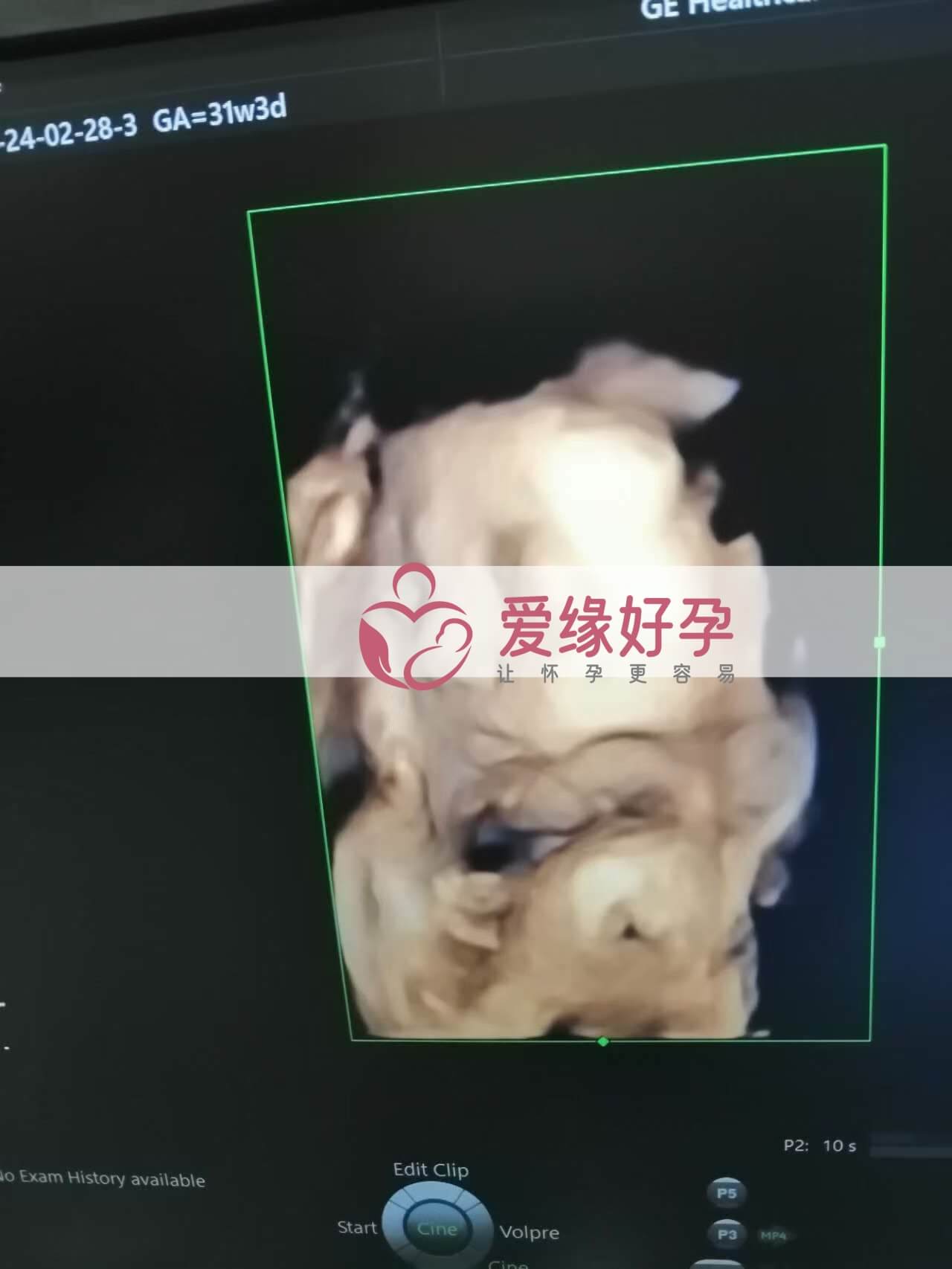 代孕代孕代母31周孕检顺利通过