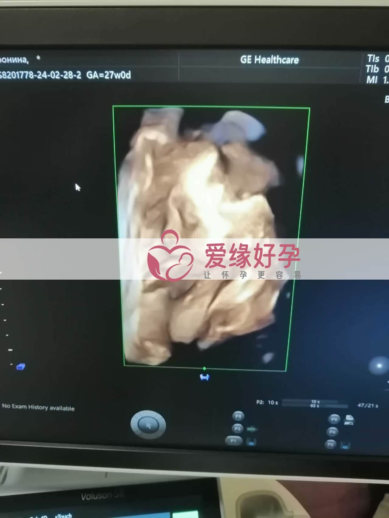 代孕代孕代母27周孕检顺利通过