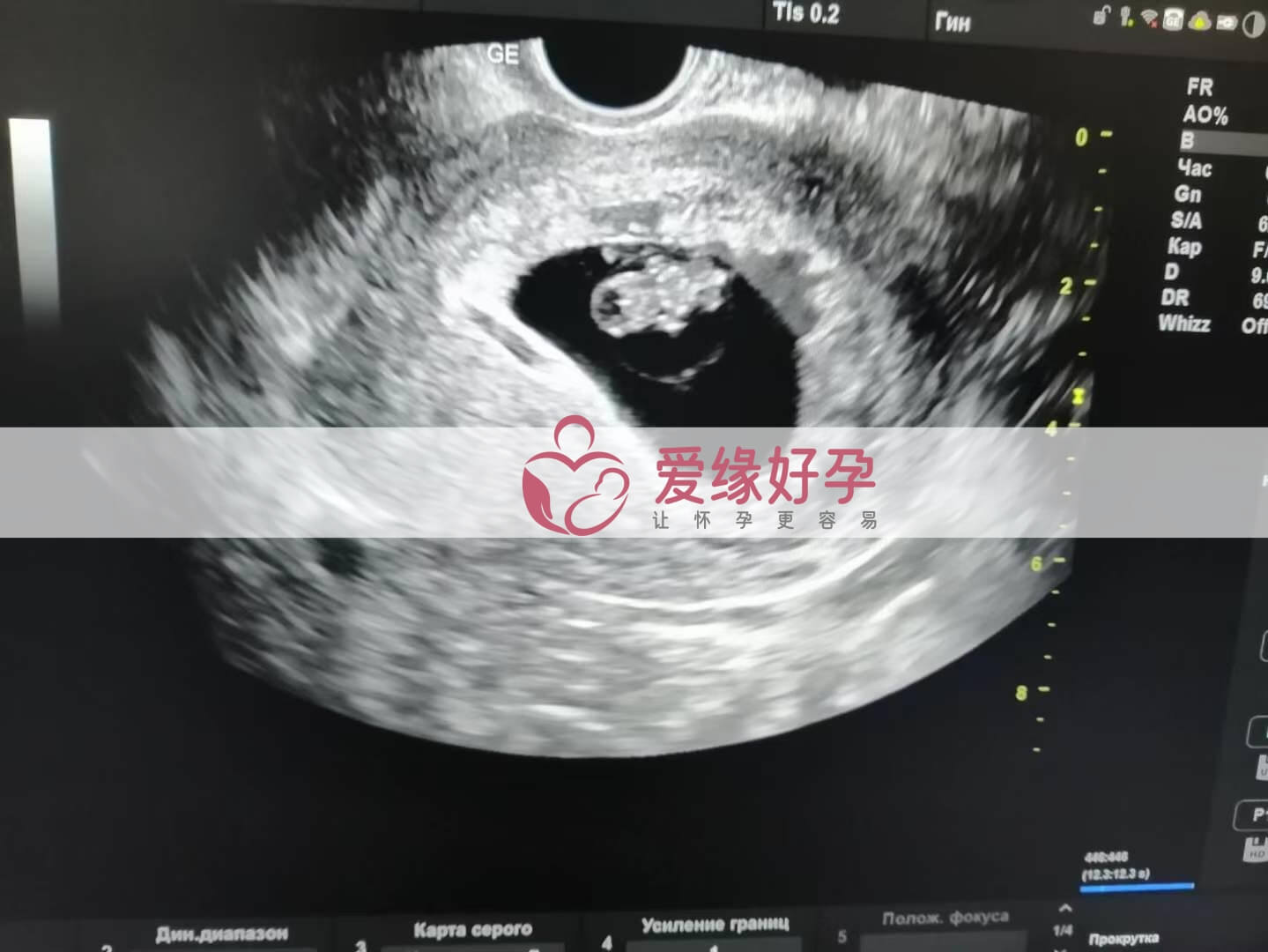 代孕代孕代母8周孕检顺利通过