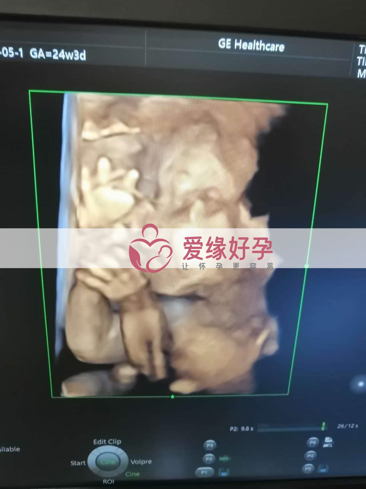 代孕代孕代母24周产检顺利通过