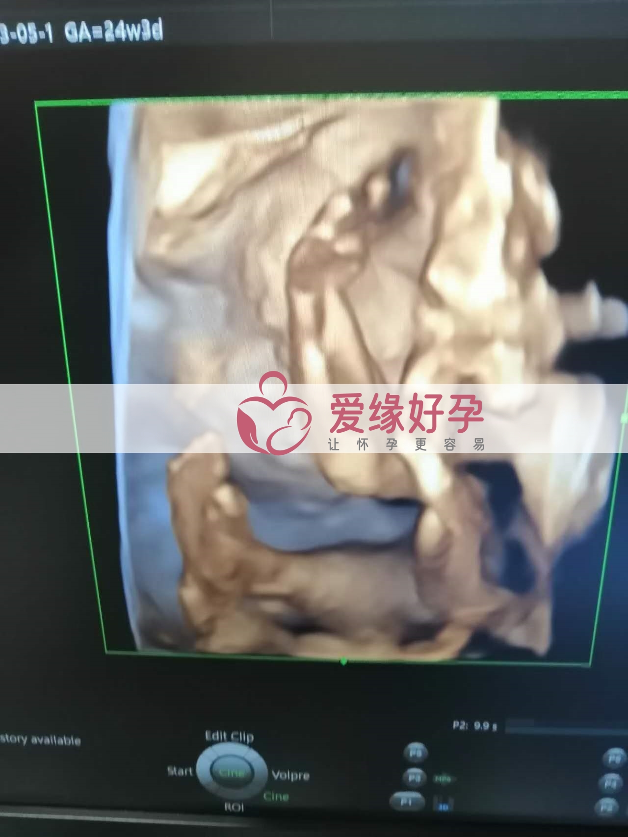 代孕代孕代母24周产检顺利通过