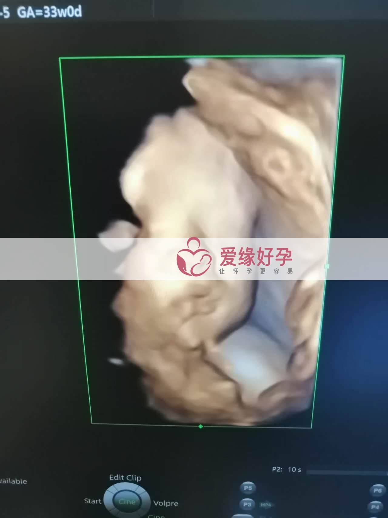 代孕代孕代母33周孕检通过