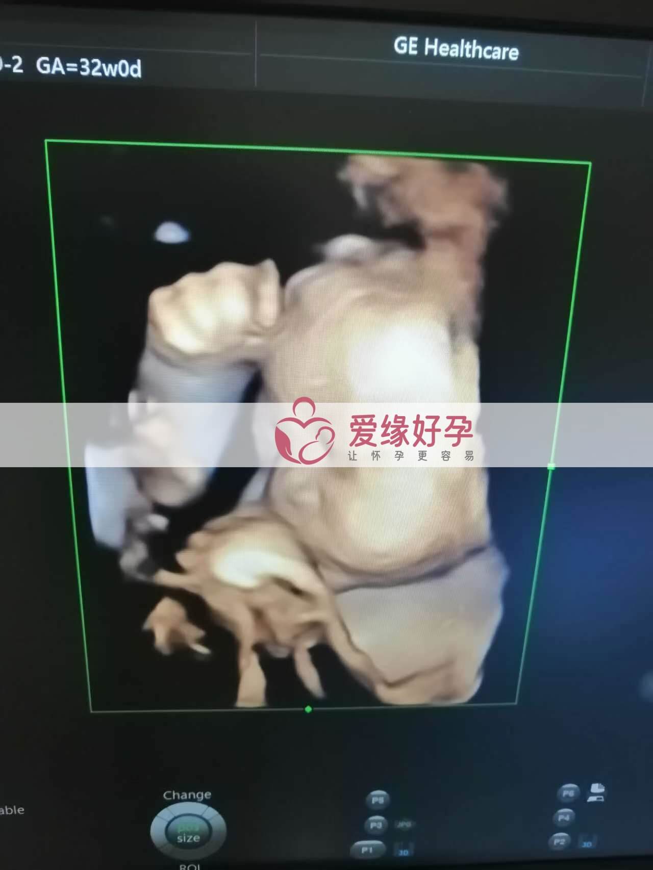 代孕代孕代母32周产检顺利通过