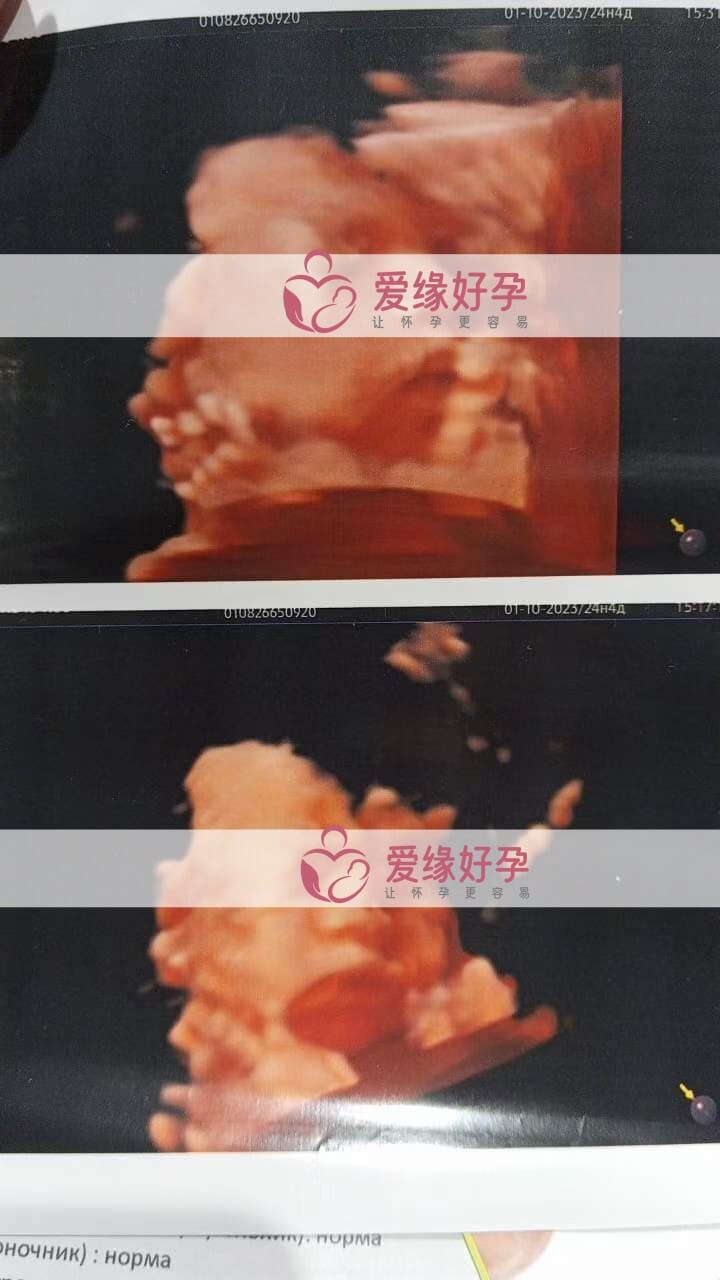 代孕代孕代母四维彩超顺利通过