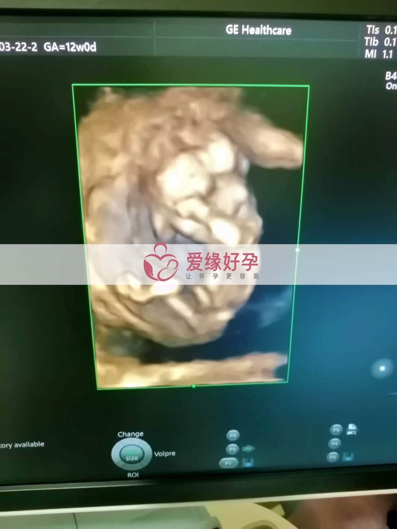 代孕代孕代母12周孕检通过