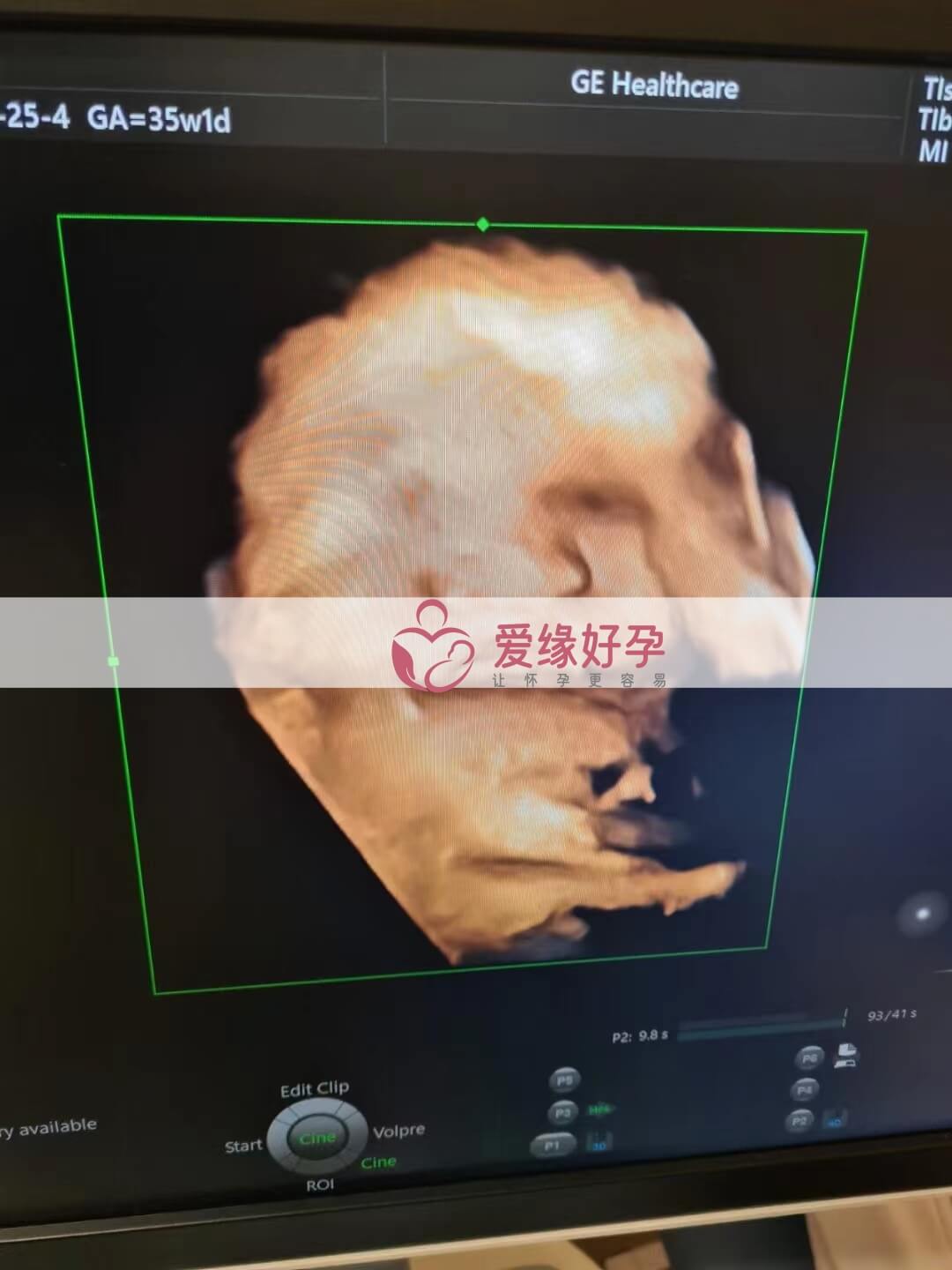 代孕代孕代母35周孕检顺利通过