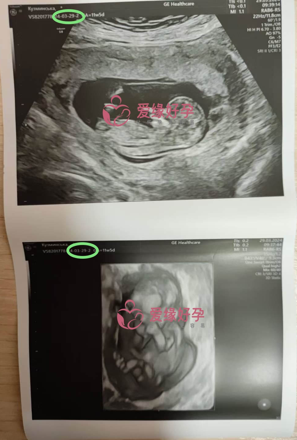 代孕代孕代母12周孕检顺利通过