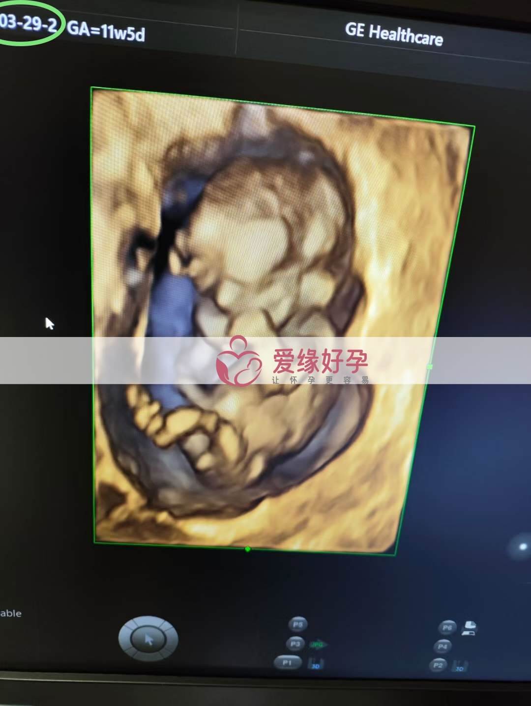 代孕代孕代母12周孕检顺利通过