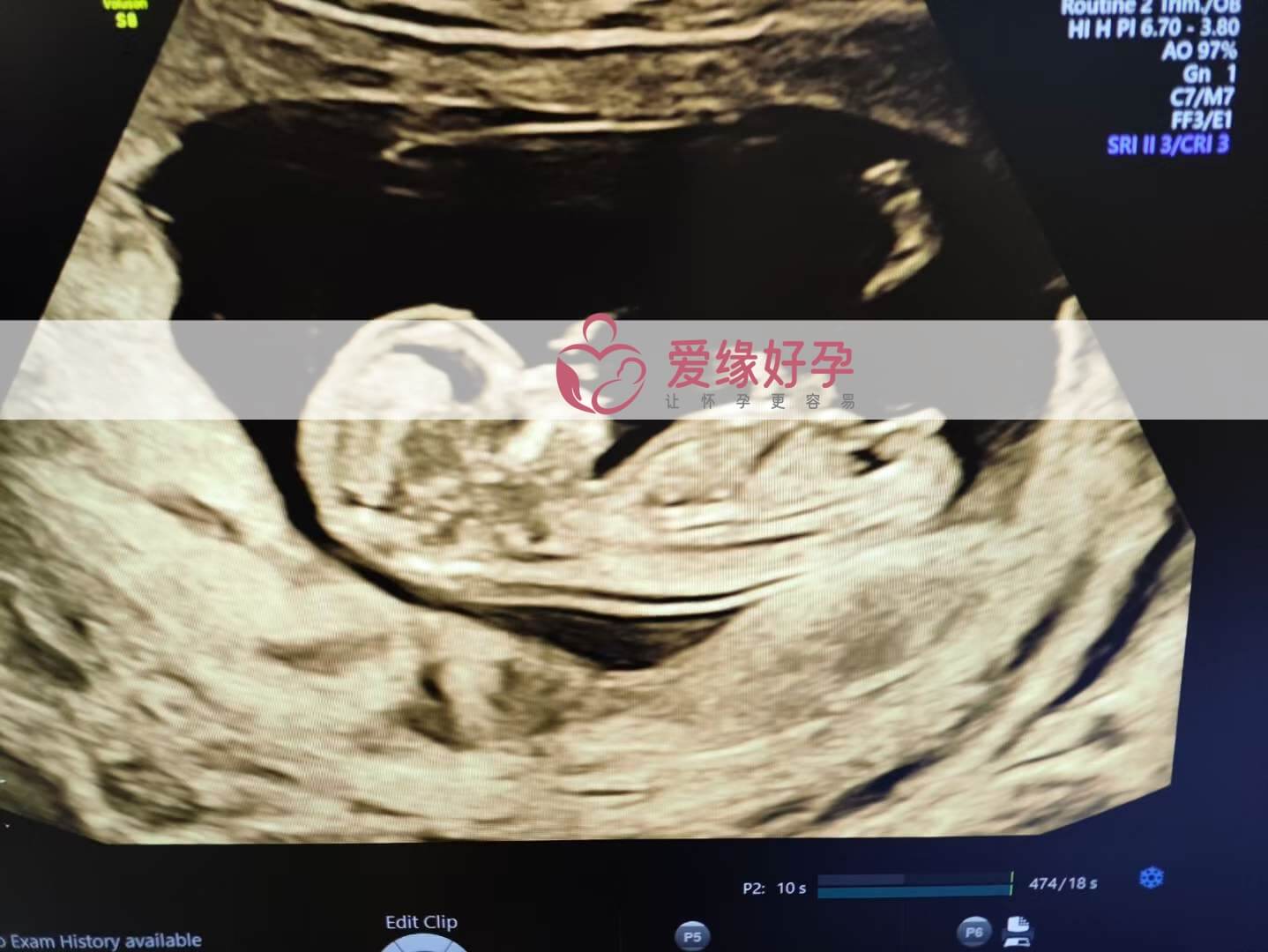 代孕代孕代母12周孕检顺利通过！
