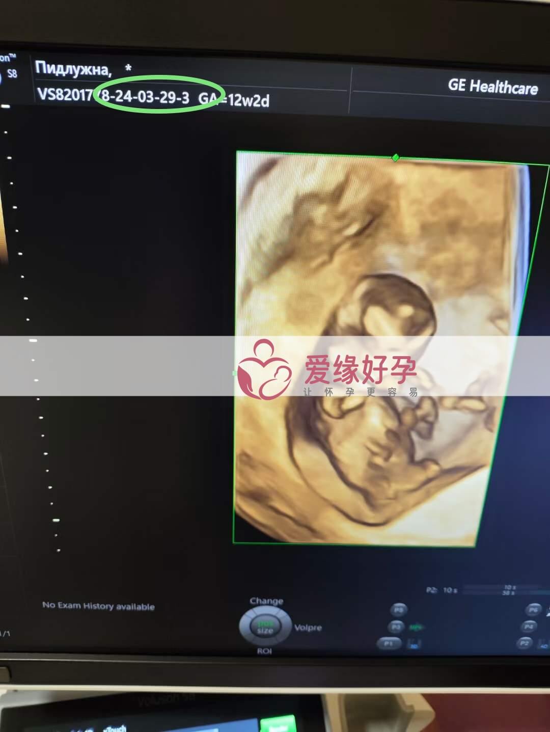 代孕代孕代母12周孕检顺利通过！