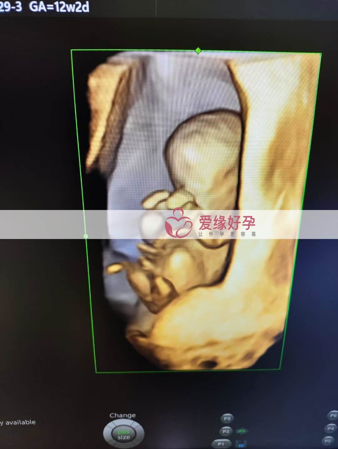 代孕代孕代母12周孕检顺利通过！