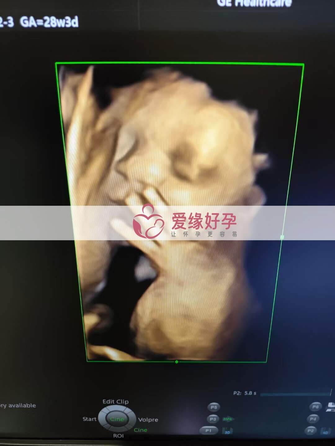 代孕代孕代母28周孕检顺利通过！