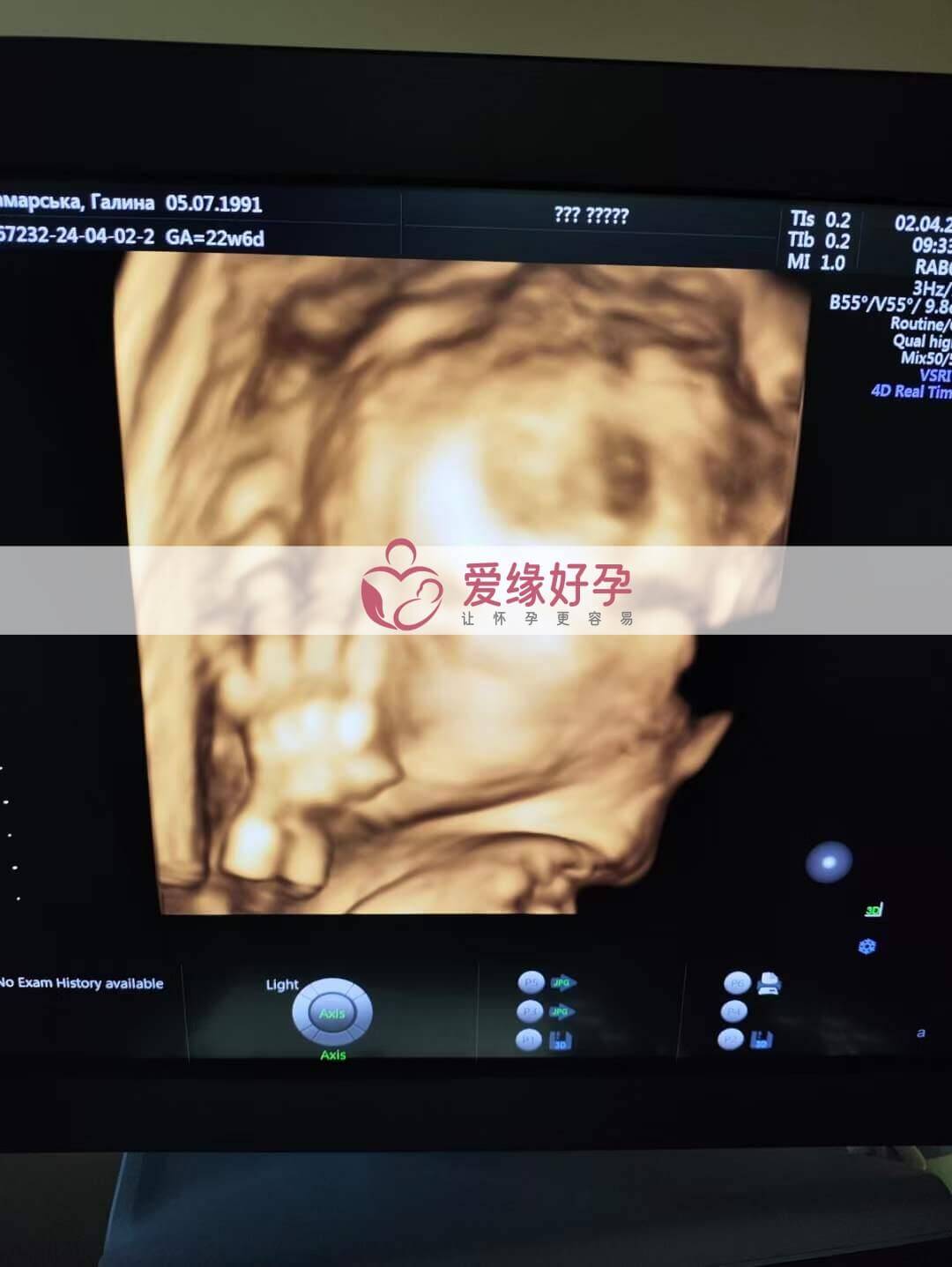 代孕代孕代母22周孕检顺利通过！
