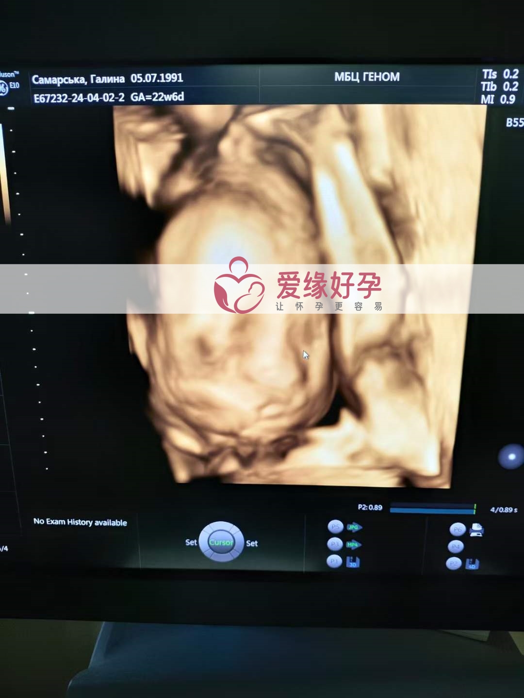 代孕代孕代母22周孕检顺利通过！