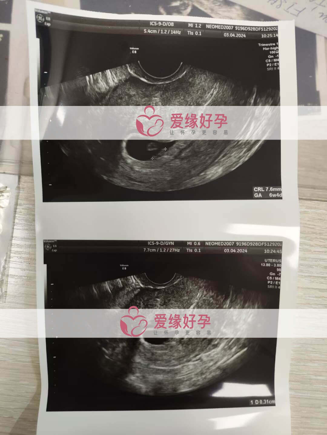 代孕代孕代母6周孕检顺利通过！