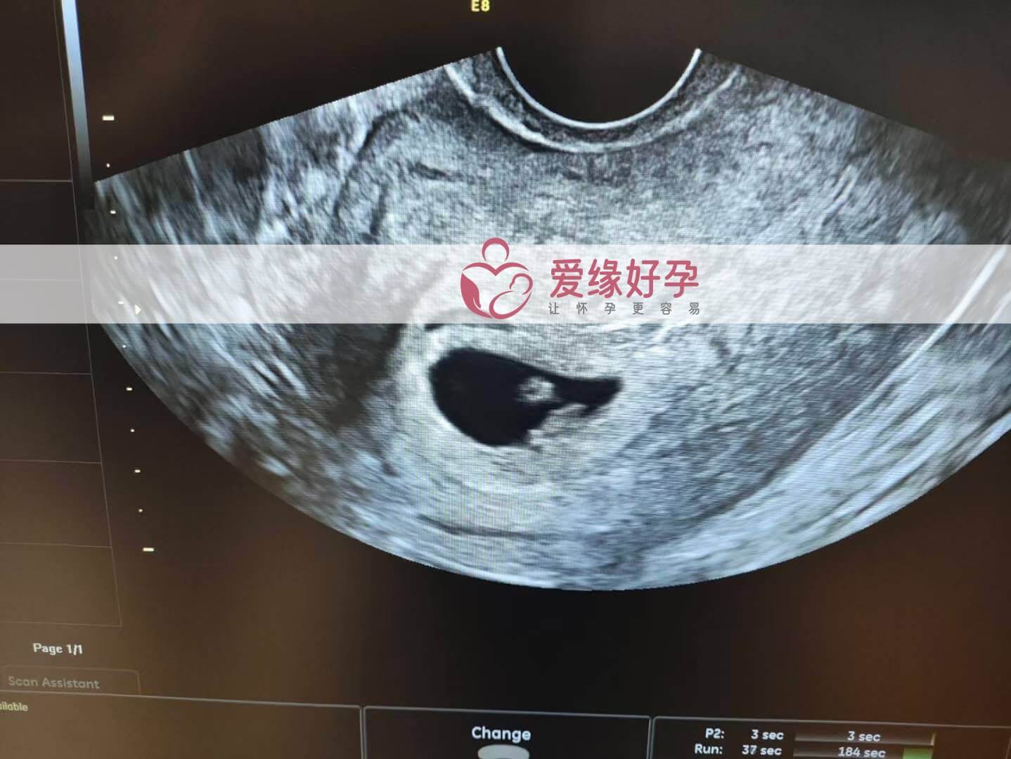 代孕代孕代母6周孕检顺利通过！