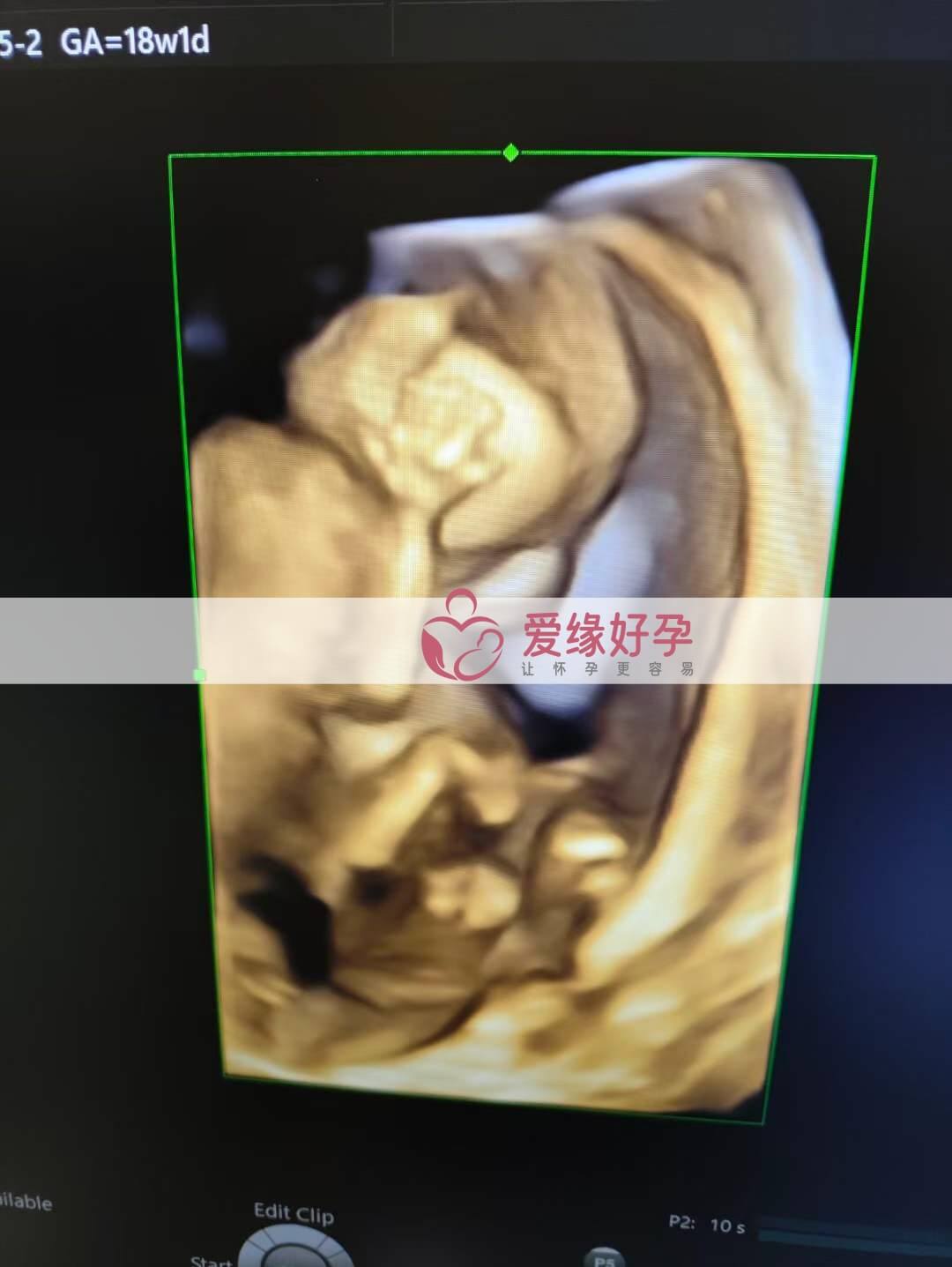 代孕代孕代母18周孕检顺利通过！