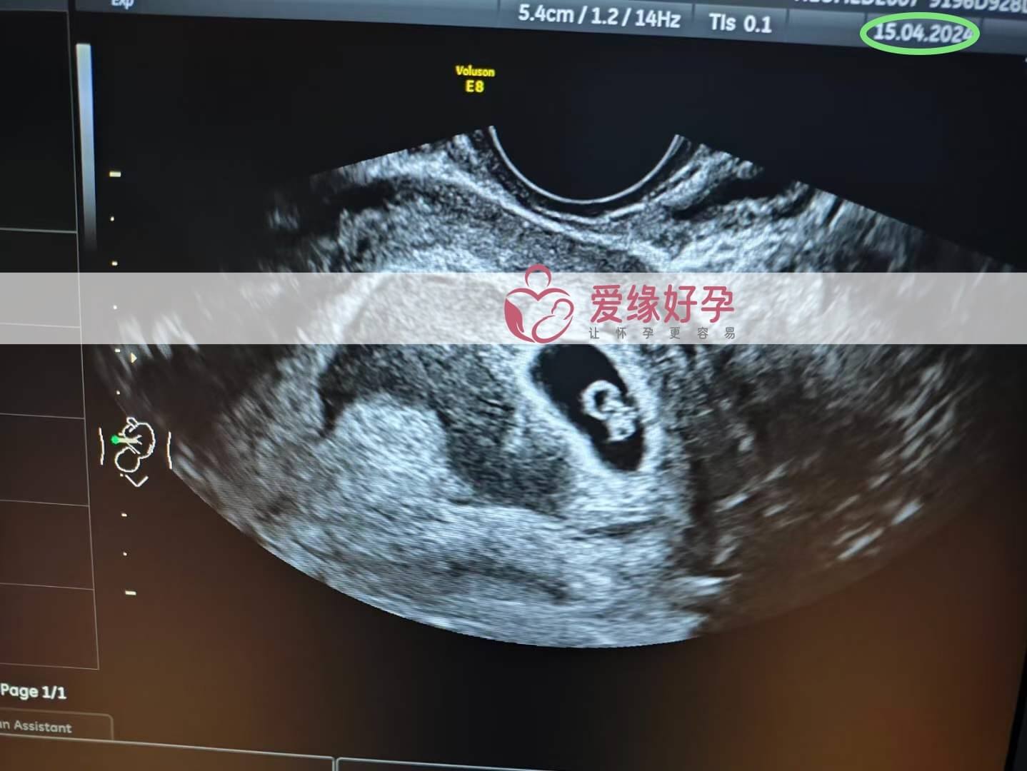 爱缘好孕:我们的代孕代母6周产检顺利通过！
