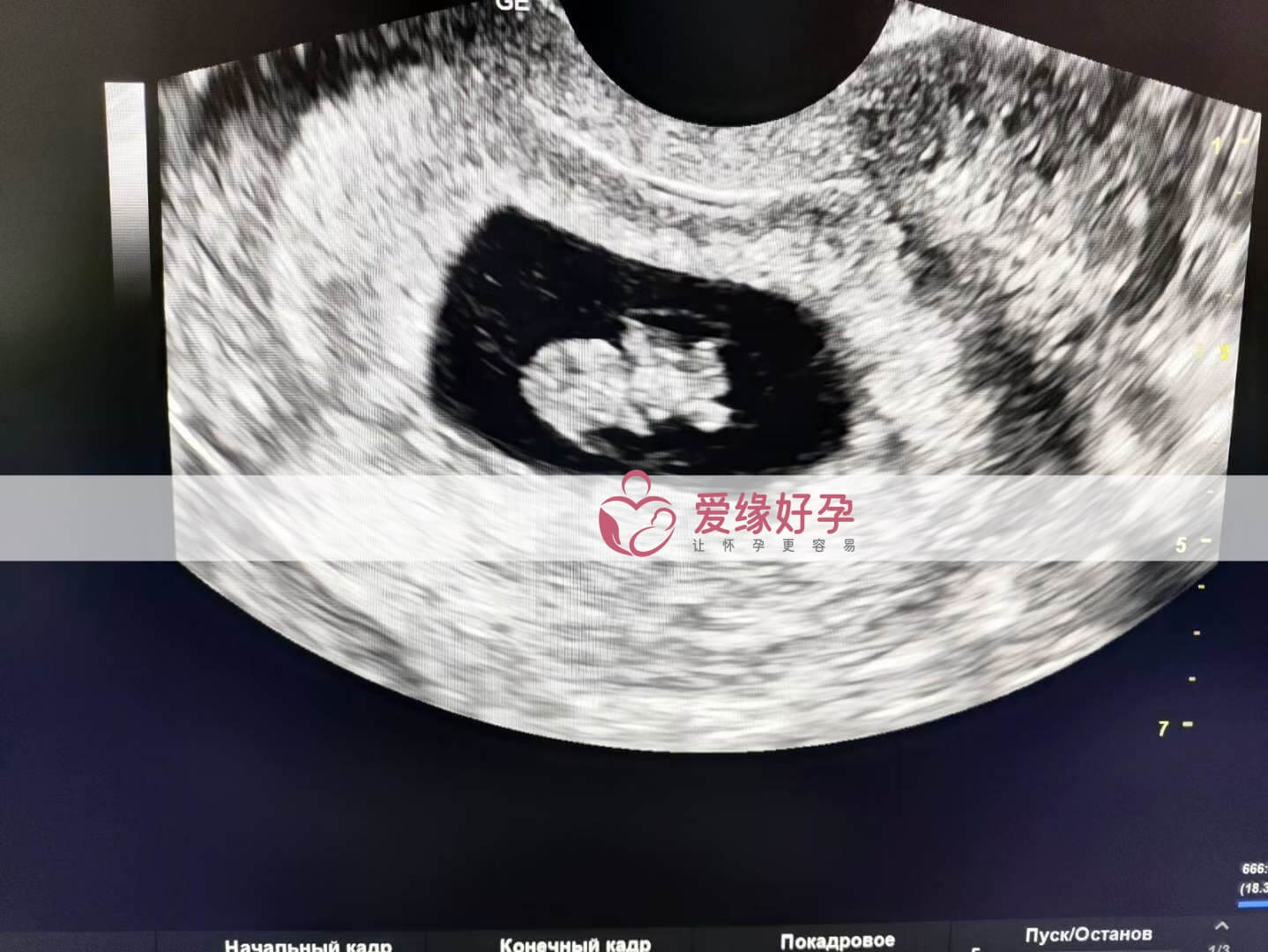 爱缘好孕：乌克兰代孕代母8周孕检顺利通过