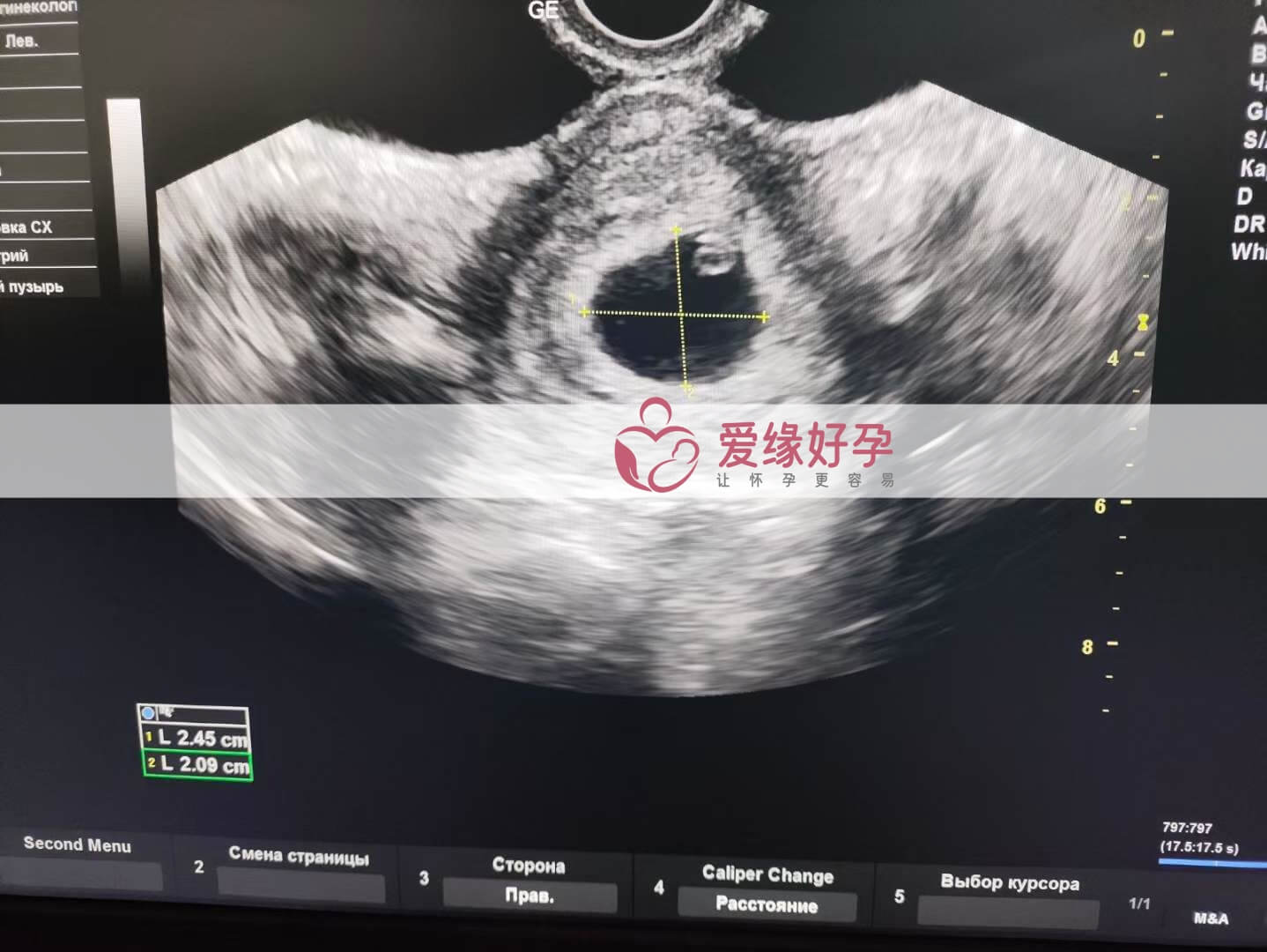 爱缘好孕：乌克兰代孕代母5周孕检顺利通过