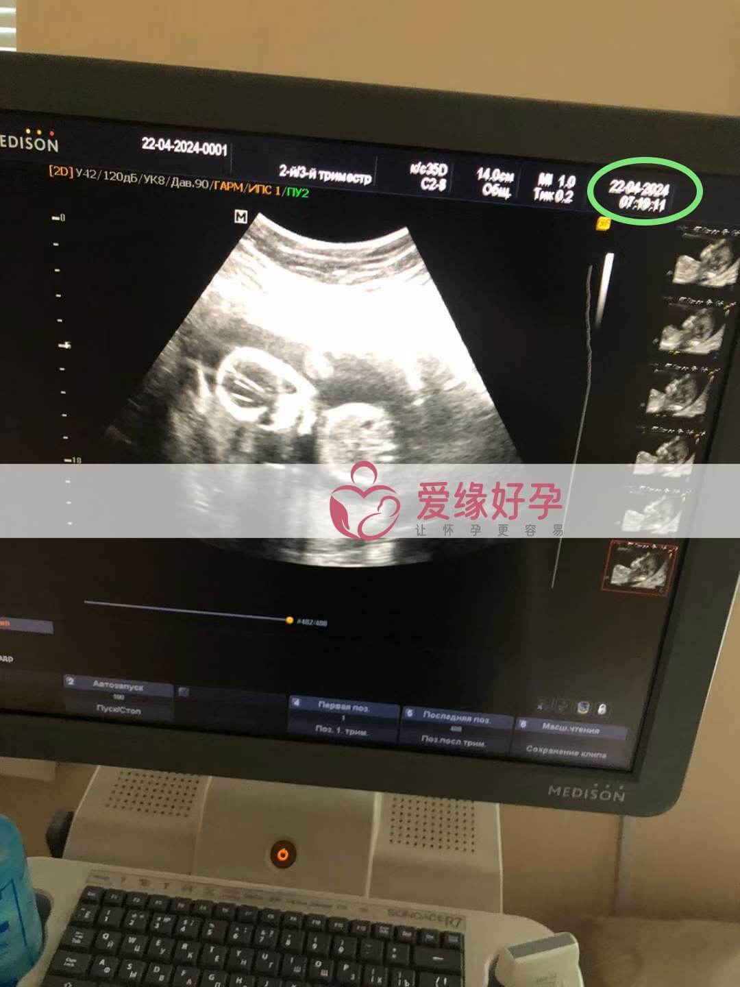 爱缘好孕：乌克兰的代孕代母孕16周产检顺利通过拉