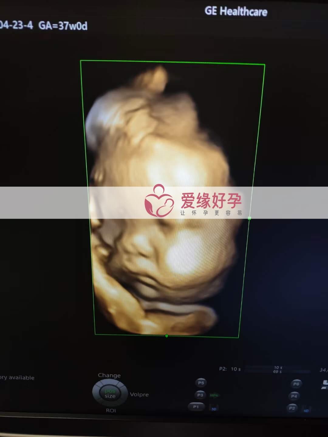 爱缘好孕：乌克兰代孕代母37周孕检顺利通过