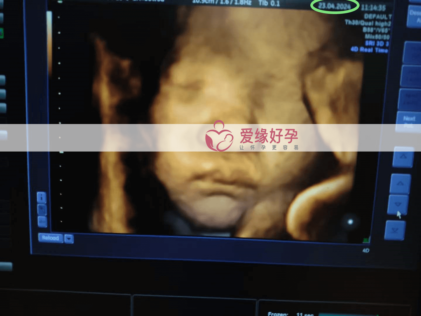 爱缘好孕：乌克兰代孕代母35周孕检顺利通过