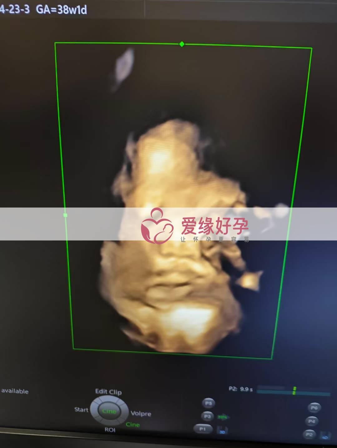 爱缘好孕：乌克兰代孕代母37周孕检顺利通过