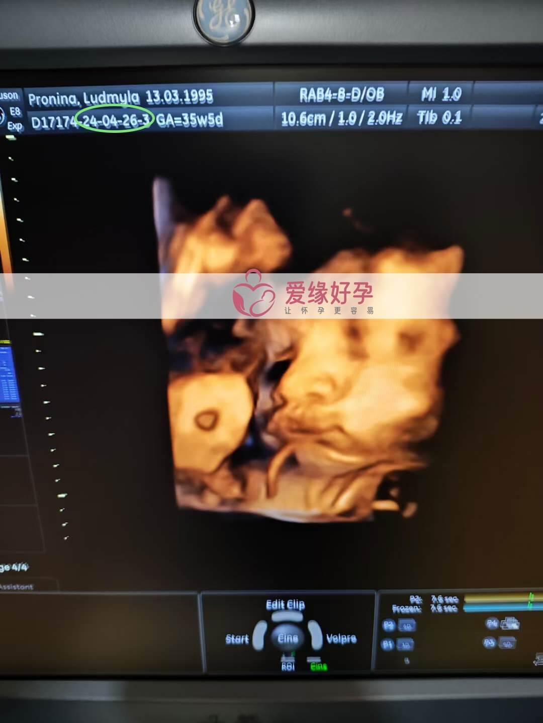 爱缘好孕: 乌克兰代孕代母34周孕检顺利通过