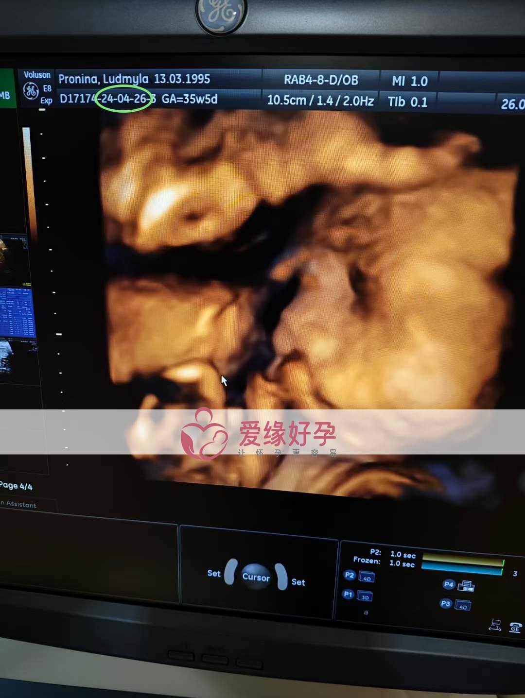 爱缘好孕: 乌克兰代孕代母34周孕检顺利通过