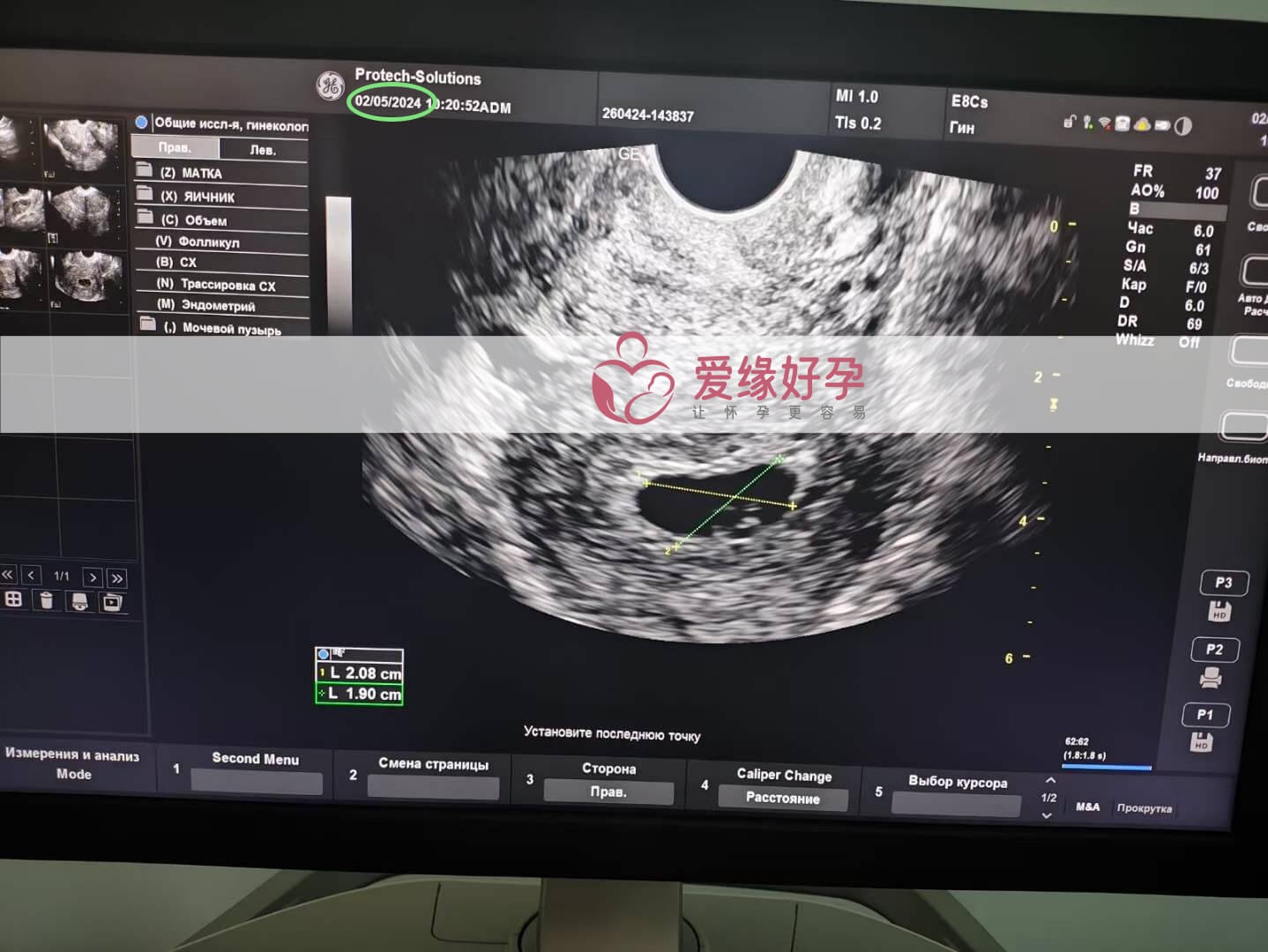 爱缘好孕:乌克兰代孕代母5周孕检顺利通过！