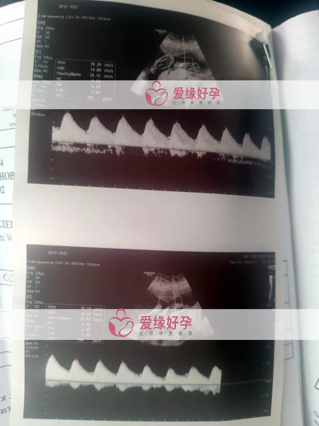 爱缘好孕:哈萨克斯坦代孕代母25周孕检顺利通过