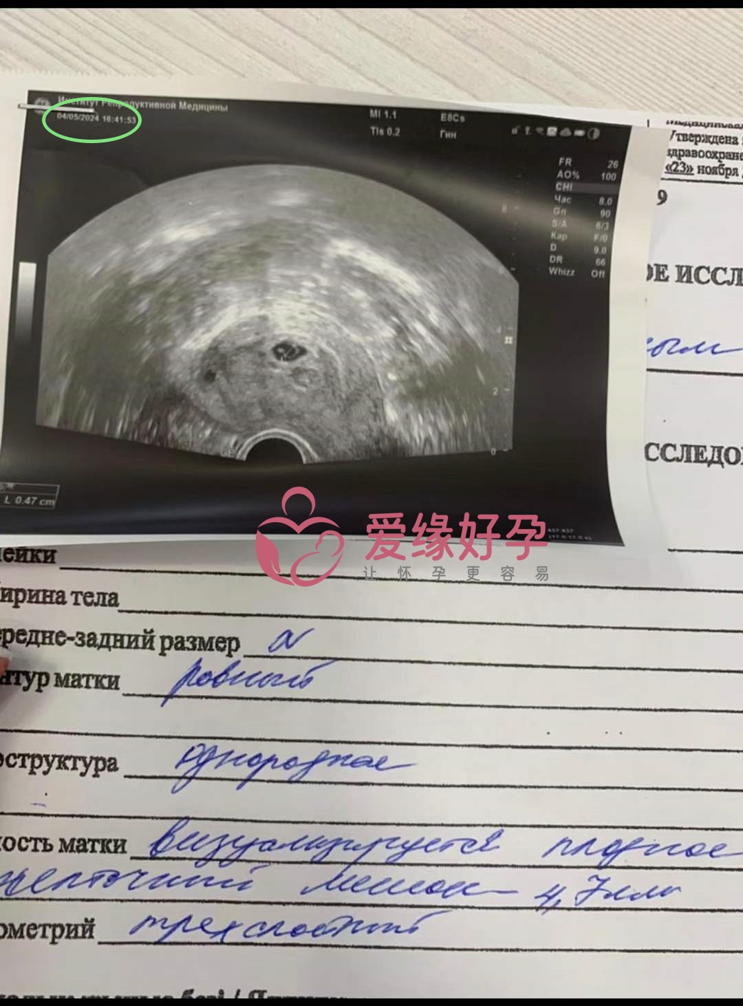 爱缘好孕:哈萨克斯坦代孕代母第一次B超顺利通过