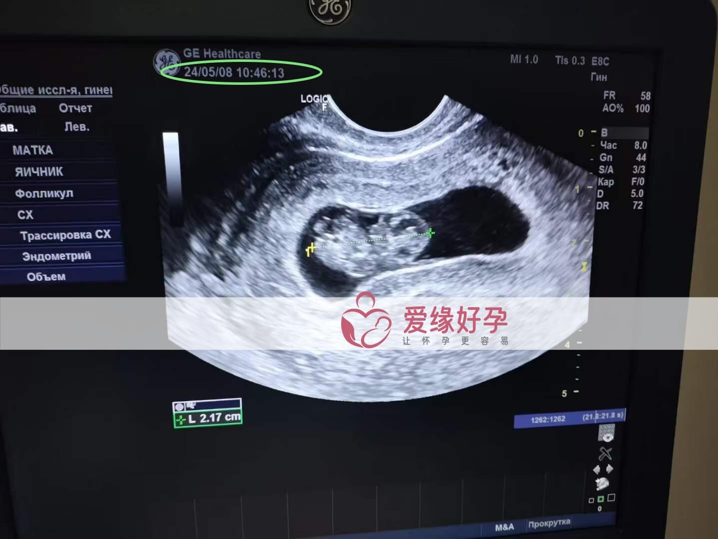 爱缘好孕:乌克兰代孕代母8周孕检顺利通过